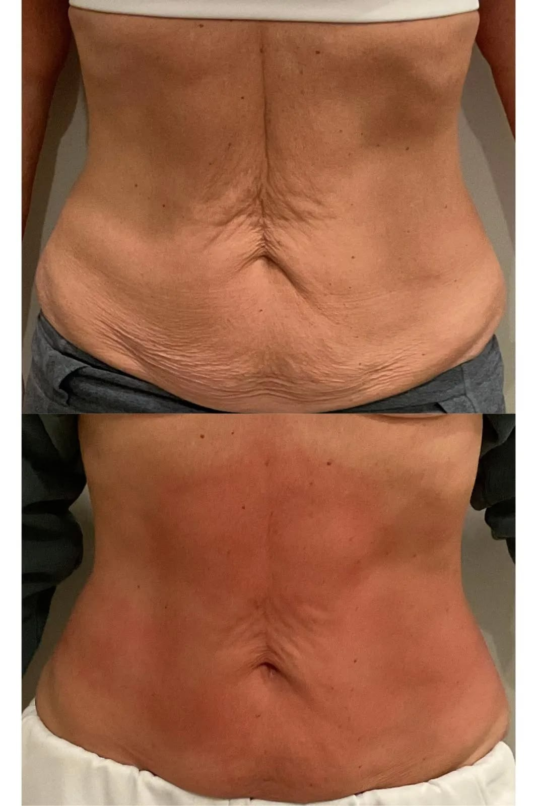 Client body contouring before and after 1