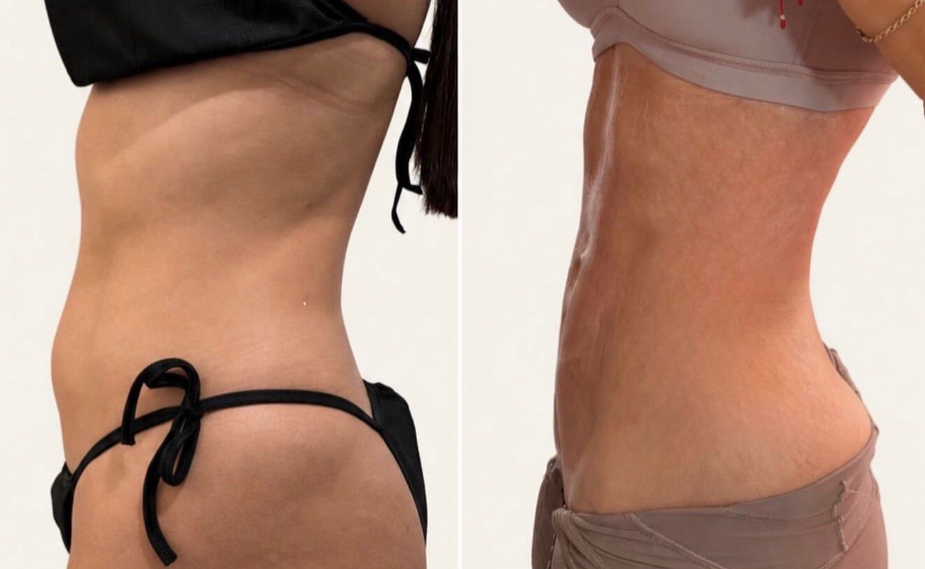 Client body contouring before and after 4