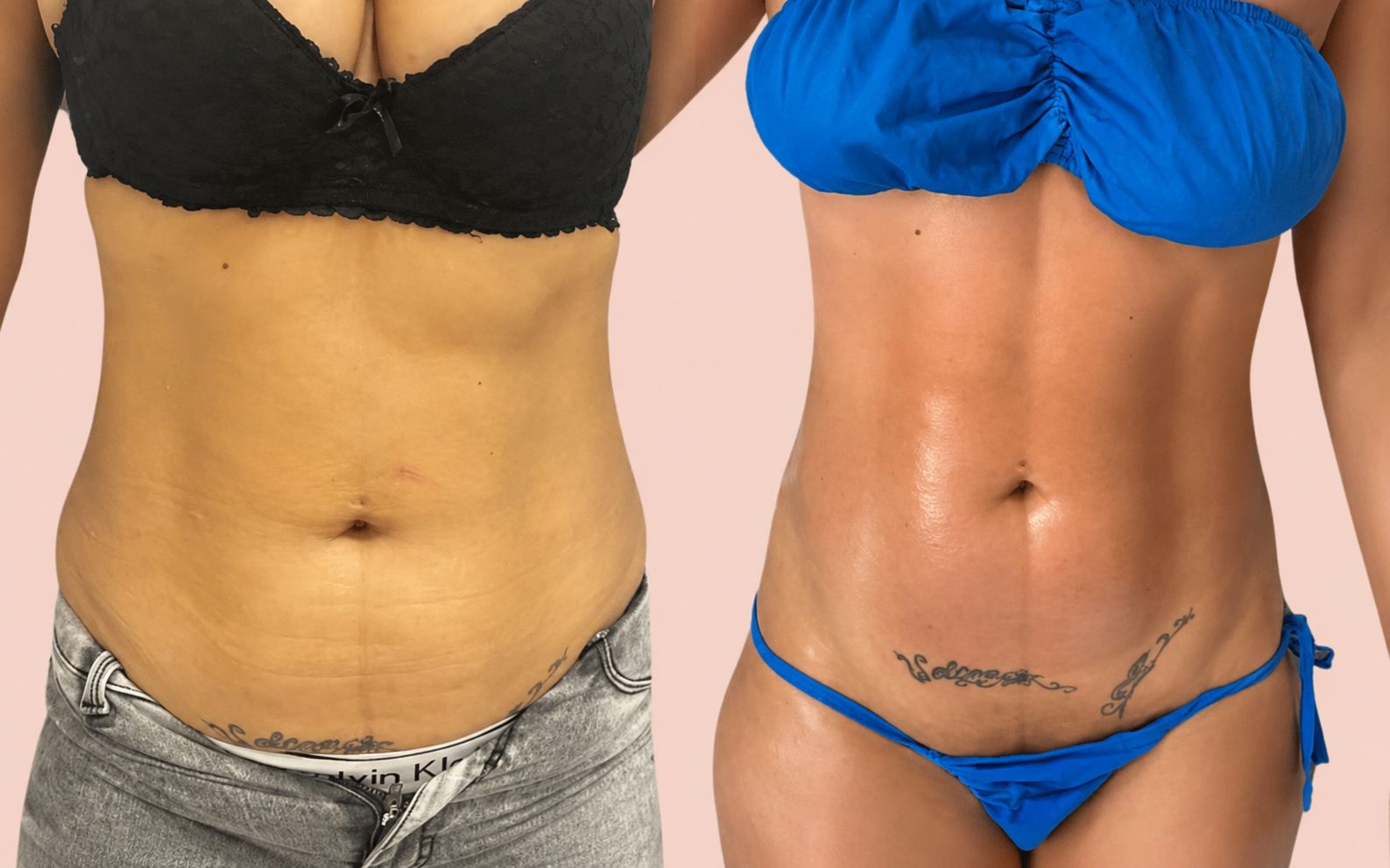 Client body contouring before and after 3