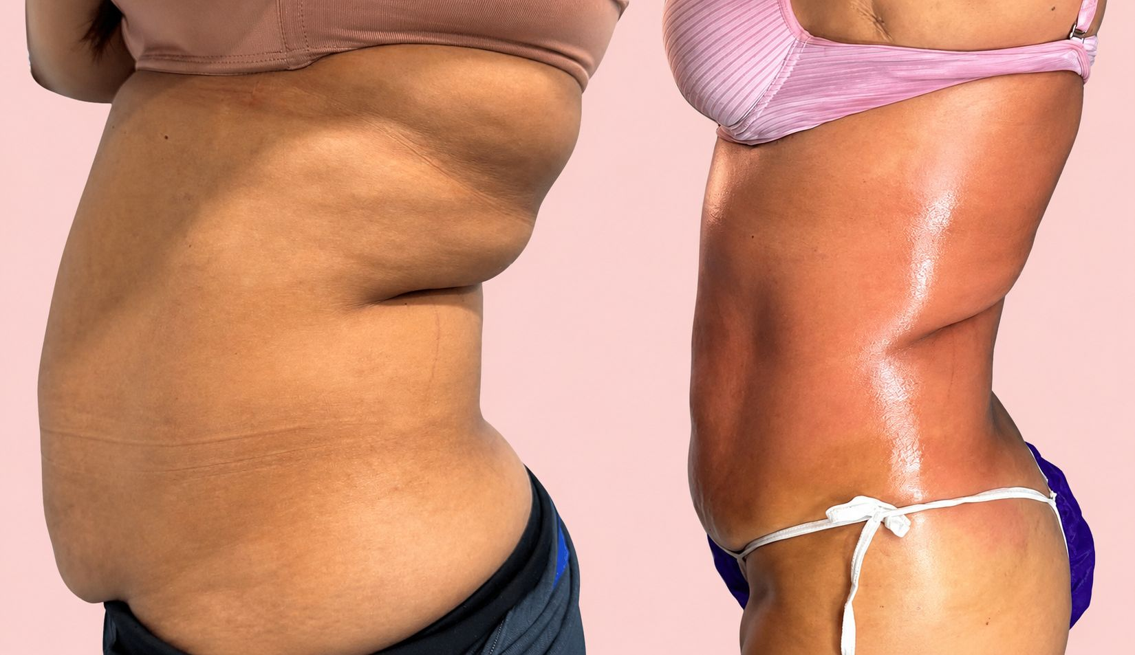Client body contouring before and after 2
